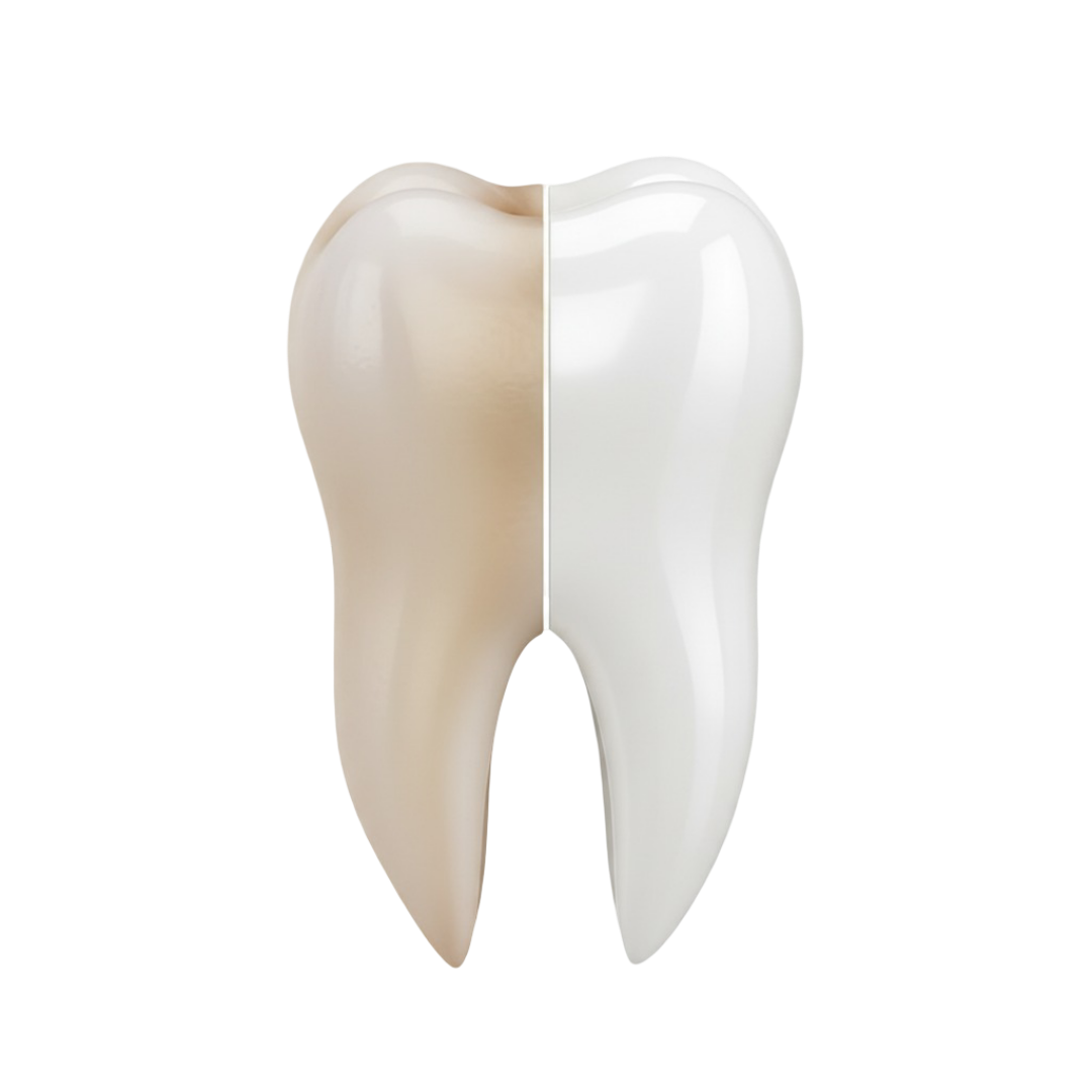 Veneers